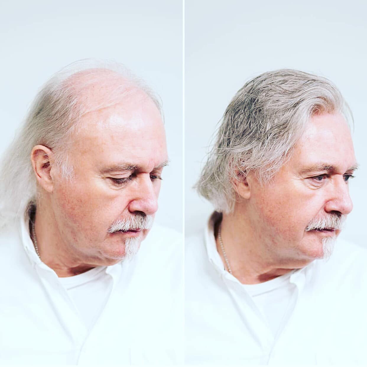 Kıbrıs Protez Saç