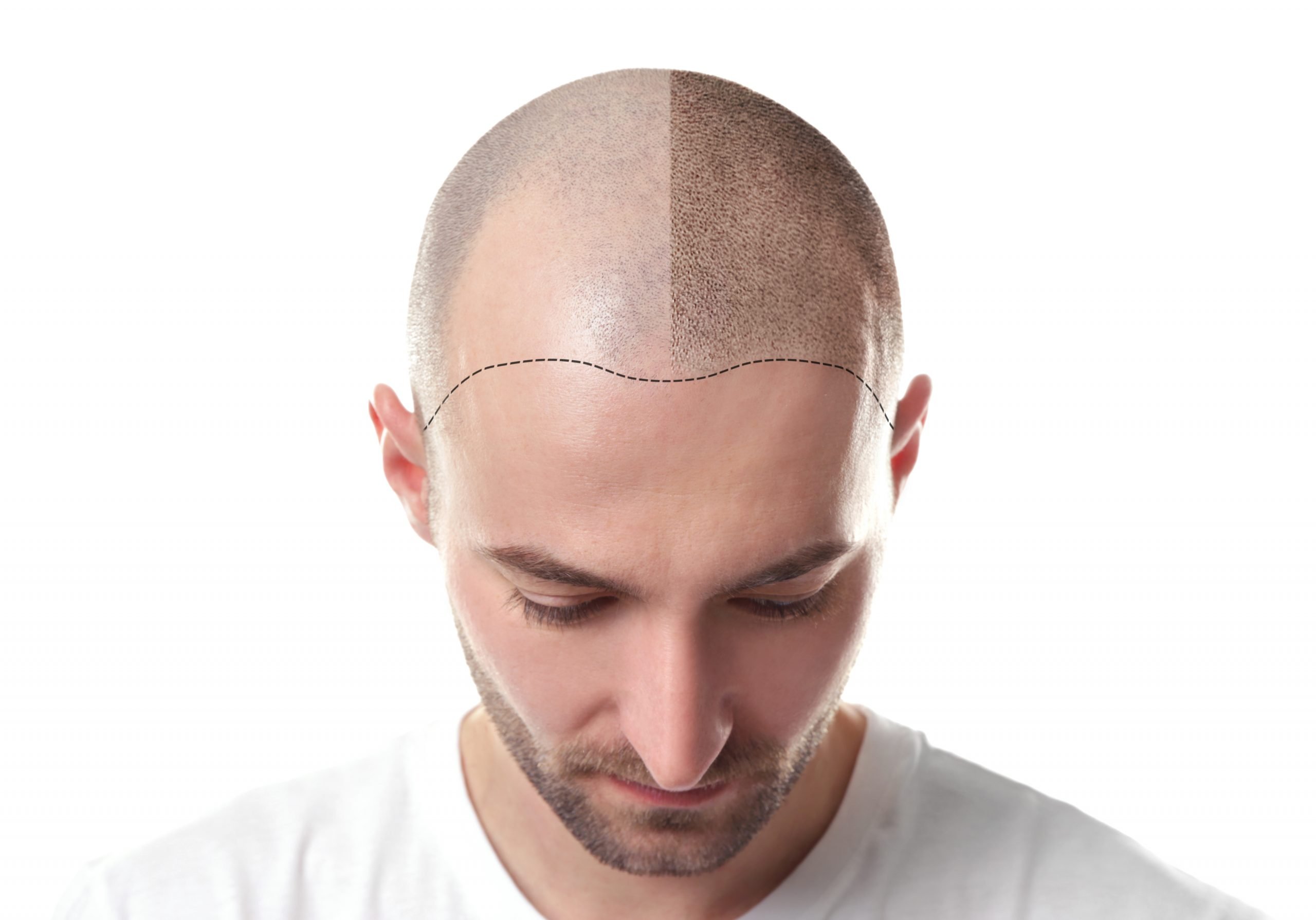Scalp Pigmentasyon
